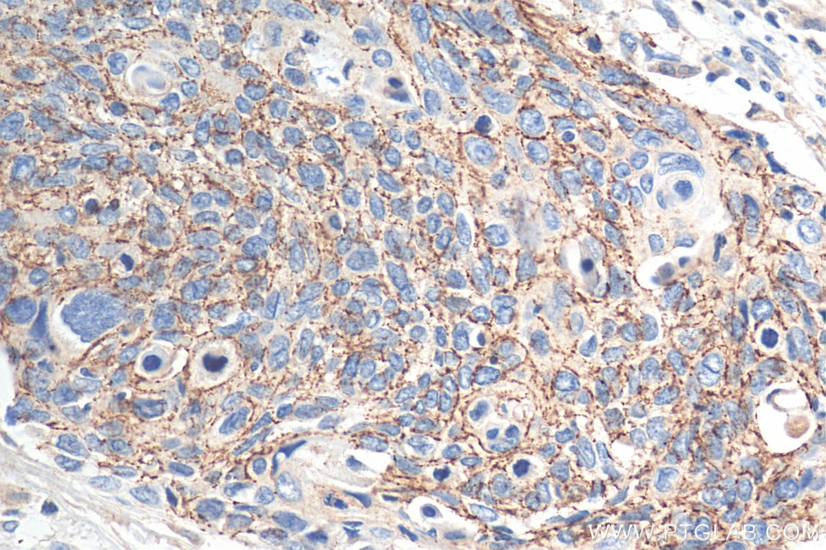 Immunohistochemistry (IHC) staining of human oesophagus cancer tissue using Claudin 7 Polyclonal antibody (29795-1-AP)