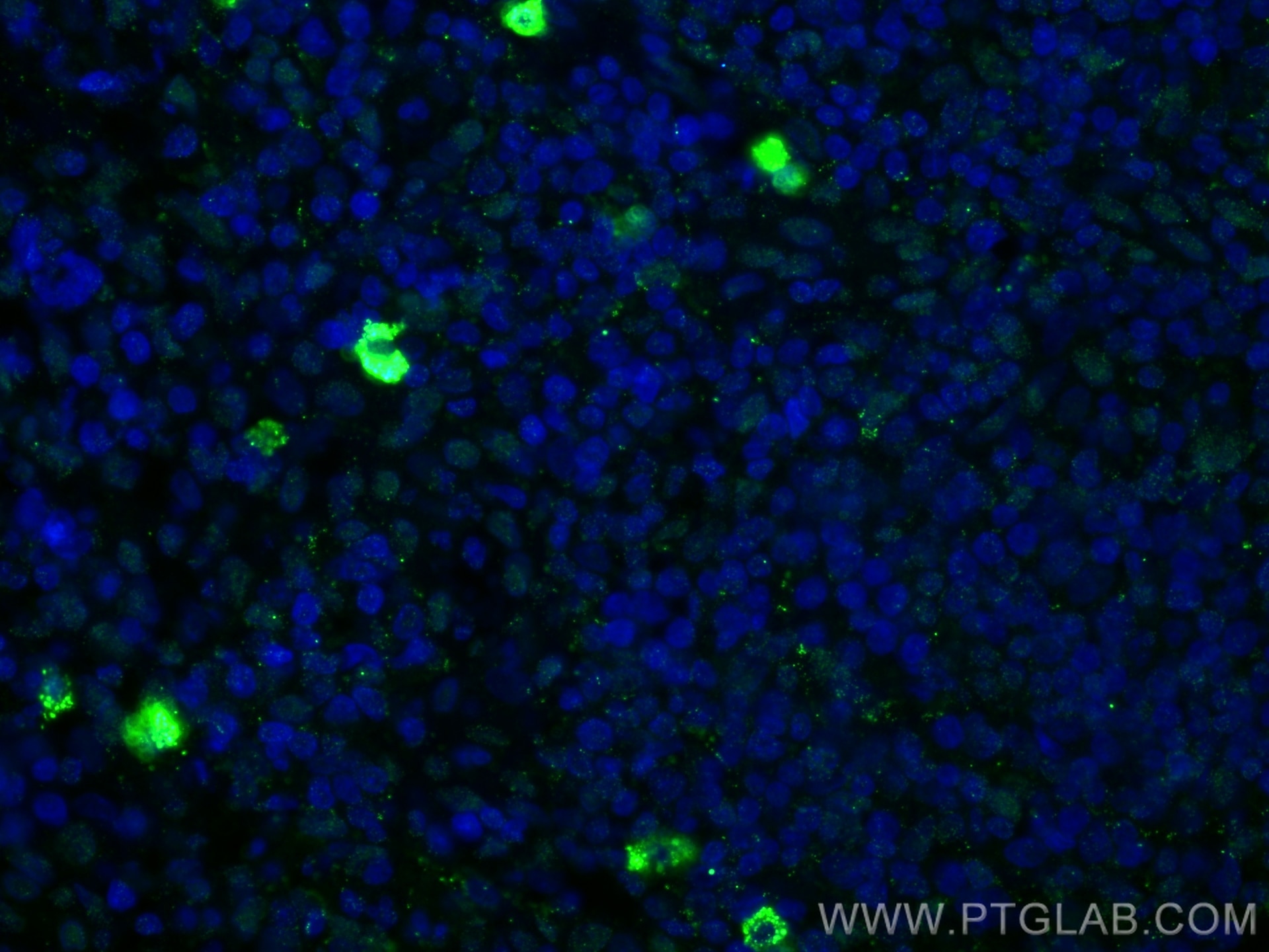 Immunofluorescence (IF) / fluorescent staining of human lymphoma tissue using SCGF Monoclonal antibody (60295-1-Ig)