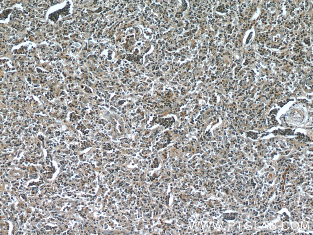 Immunohistochemistry (IHC) staining of human lymphoma tissue using SCGF Monoclonal antibody (60295-1-Ig)