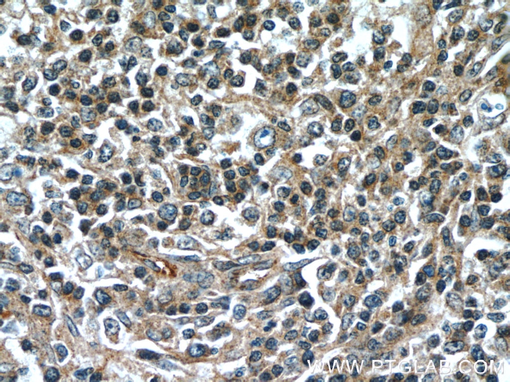 Immunohistochemistry (IHC) staining of human lymphoma tissue using SCGF Monoclonal antibody (60295-1-Ig)