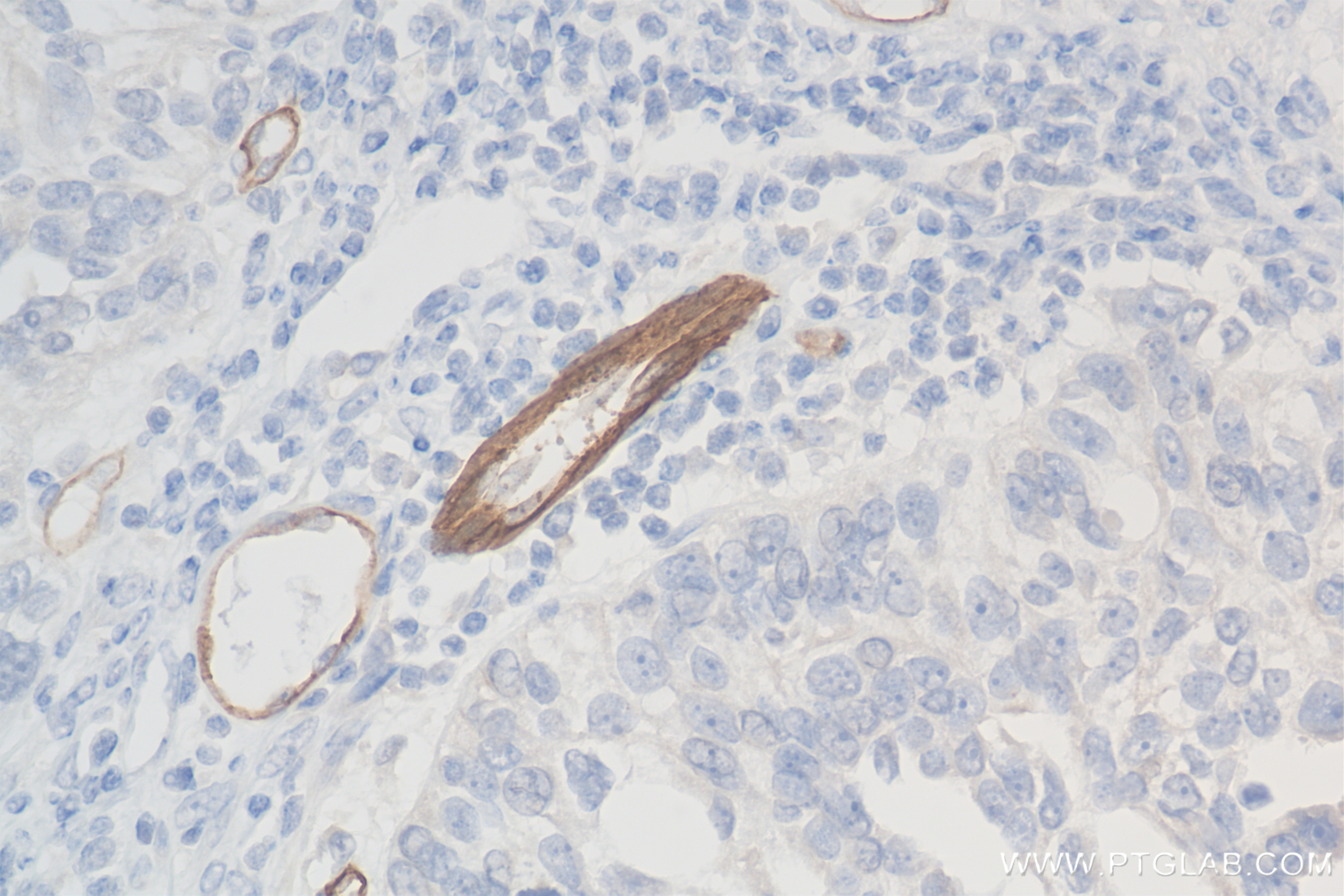 Immunohistochemistry (IHC) staining of human ovary cancer tissue using CLEC14A Recombinant antibody (84327-1-RR)