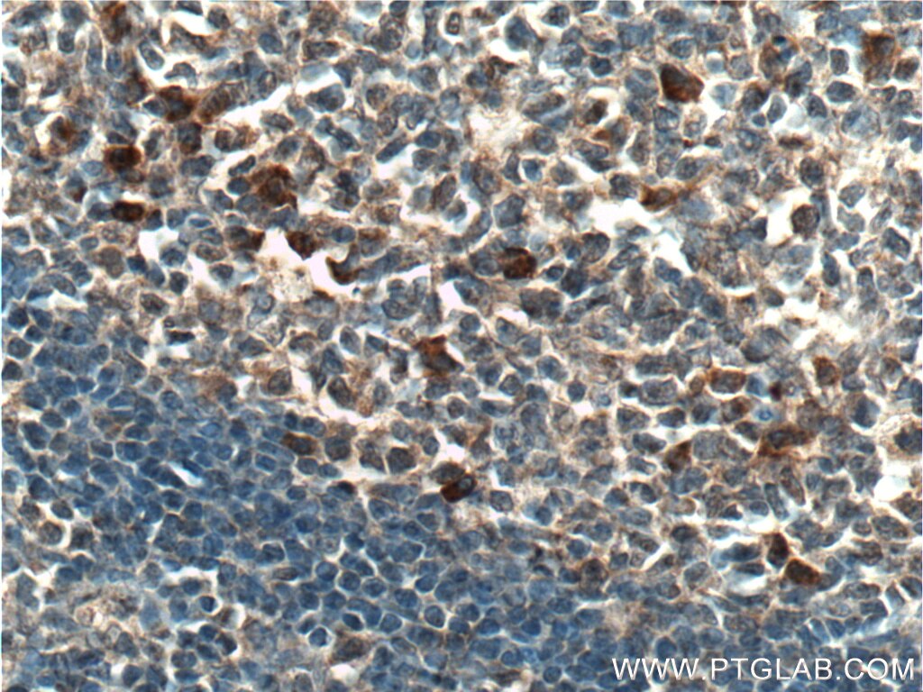 Immunohistochemistry (IHC) staining of human tonsillitis tissue using CLEC16A Polyclonal antibody (26257-1-AP)