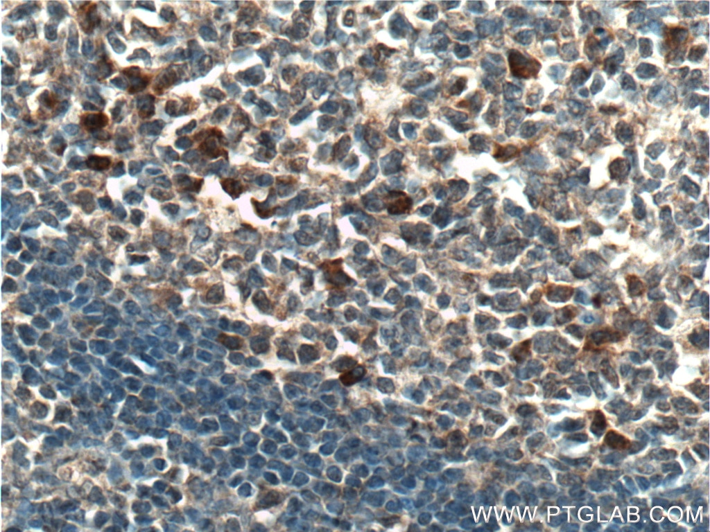 IHC staining of human tonsillitis using 26257-1-AP