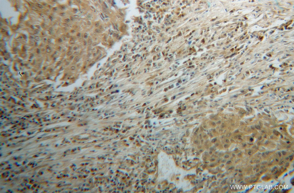 Immunohistochemistry (IHC) staining of human lung cancer tissue using CLEC1A Polyclonal antibody (13394-1-AP)