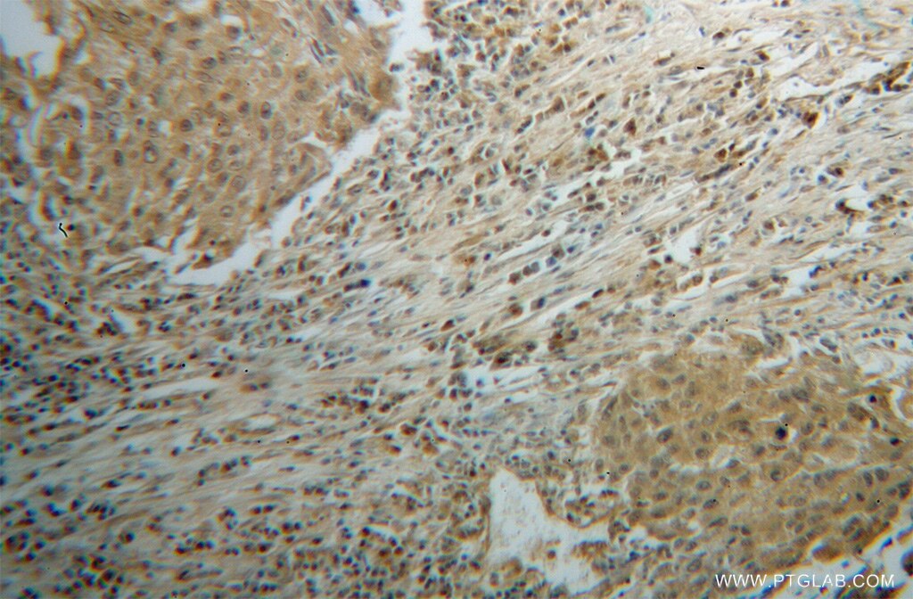 Immunohistochemistry (IHC) staining of human lung cancer tissue using CLEC1A Polyclonal antibody (13394-1-AP)