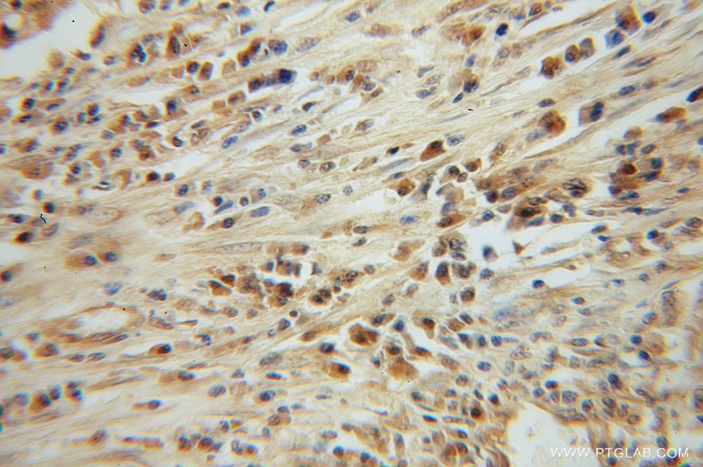 Immunohistochemistry (IHC) staining of human lung cancer tissue using CLEC1A Polyclonal antibody (13394-1-AP)