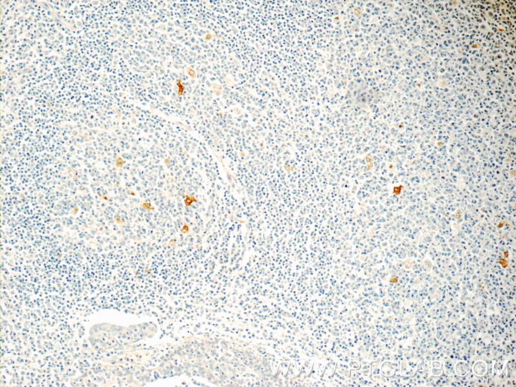 Immunohistochemistry (IHC) staining of human tonsillitis tissue using CLEC4D Polyclonal antibody (18930-1-AP)