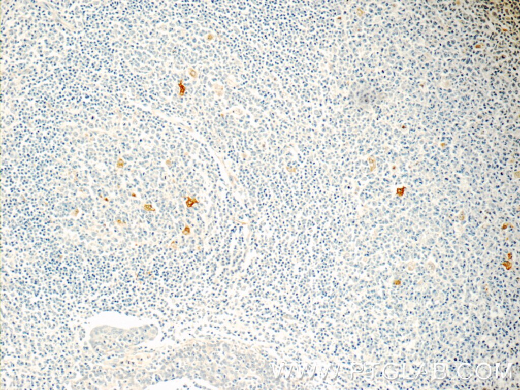Immunohistochemistry (IHC) staining of human tonsillitis tissue using CLEC4D Polyclonal antibody (18930-1-AP)
