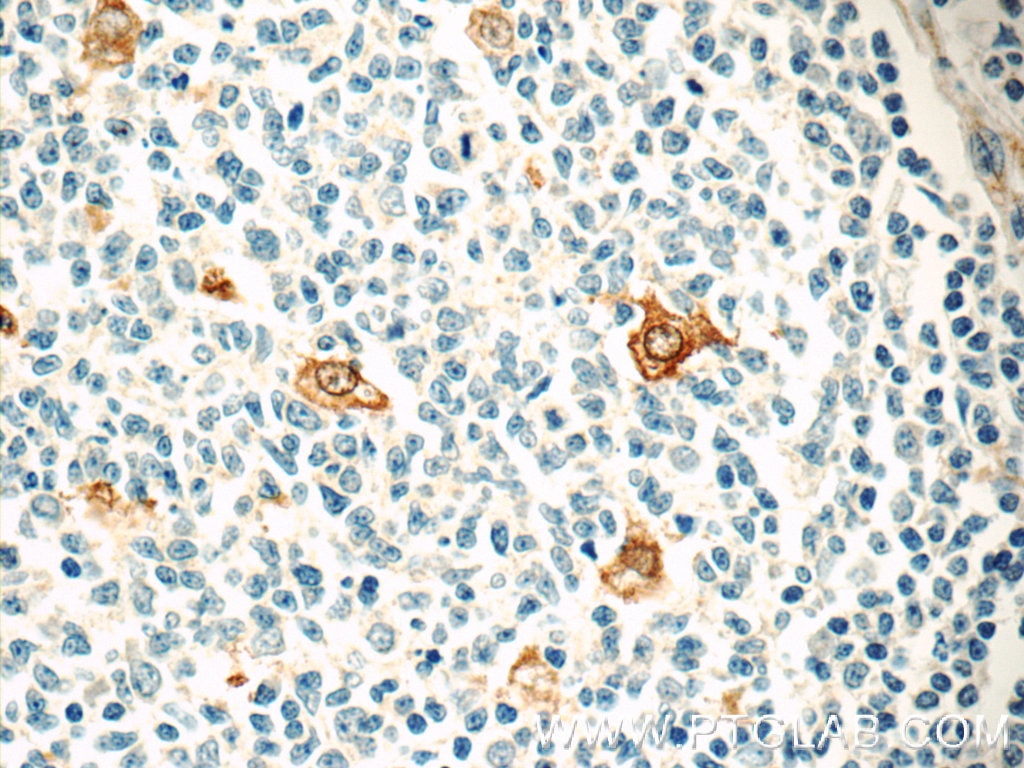 Immunohistochemistry (IHC) staining of human tonsillitis tissue using CLEC4D Polyclonal antibody (18930-1-AP)