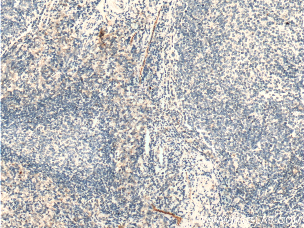 Immunohistochemistry (IHC) staining of human tonsillitis tissue using CLEC4G Polyclonal antibody (18173-1-AP)