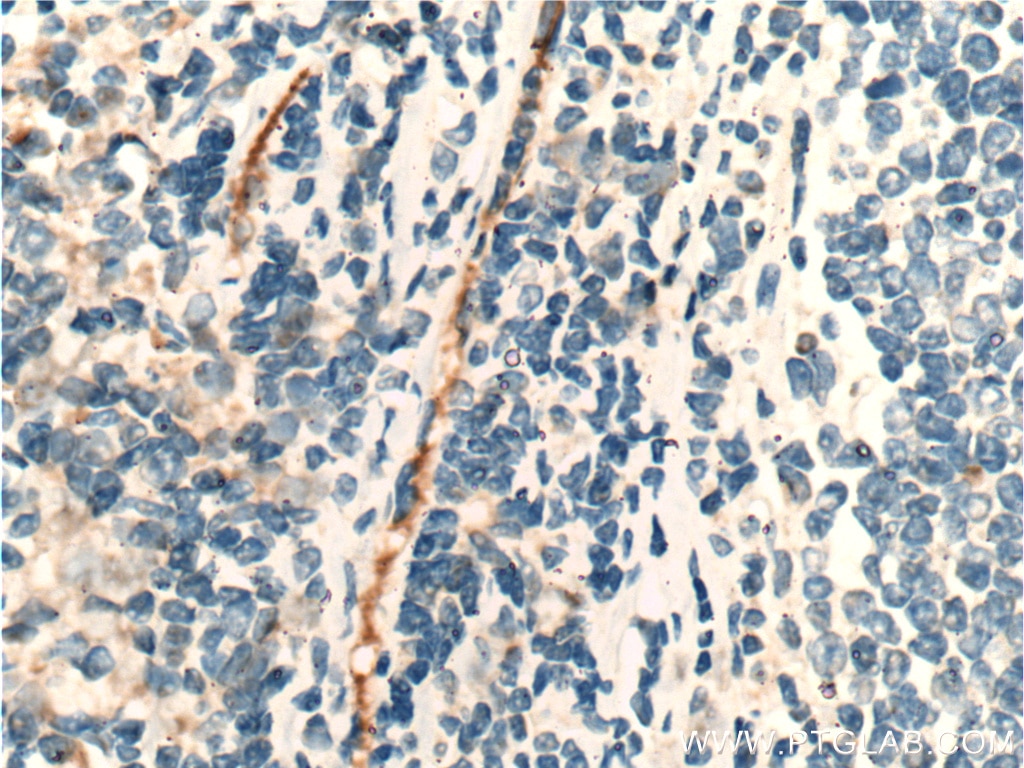 Immunohistochemistry (IHC) staining of human tonsillitis tissue using CLEC4G Polyclonal antibody (18173-1-AP)