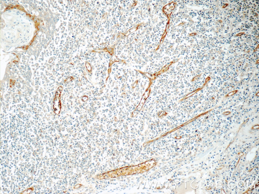 Immunohistochemistry (IHC) staining of human tonsillitis tissue using CLEC4M Polyclonal antibody (22003-1-AP)