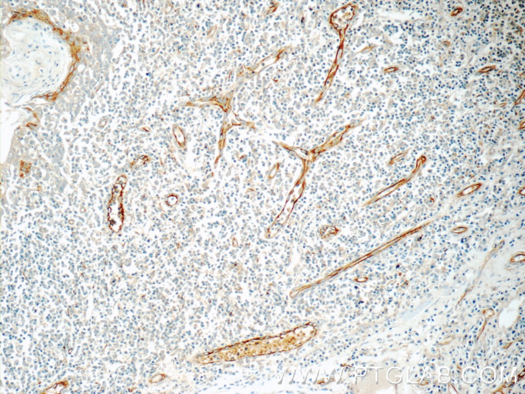 IHC staining of human tonsillitis using 22003-1-AP