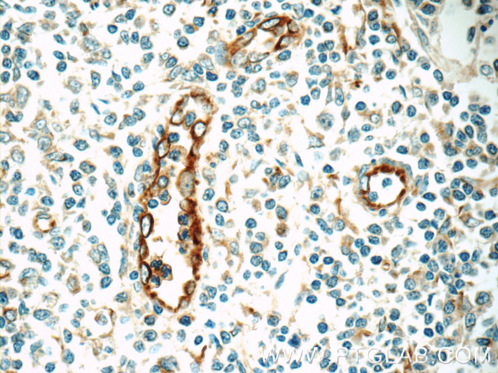 Immunohistochemistry (IHC) staining of human tonsillitis tissue using CLEC4M Polyclonal antibody (22003-1-AP)