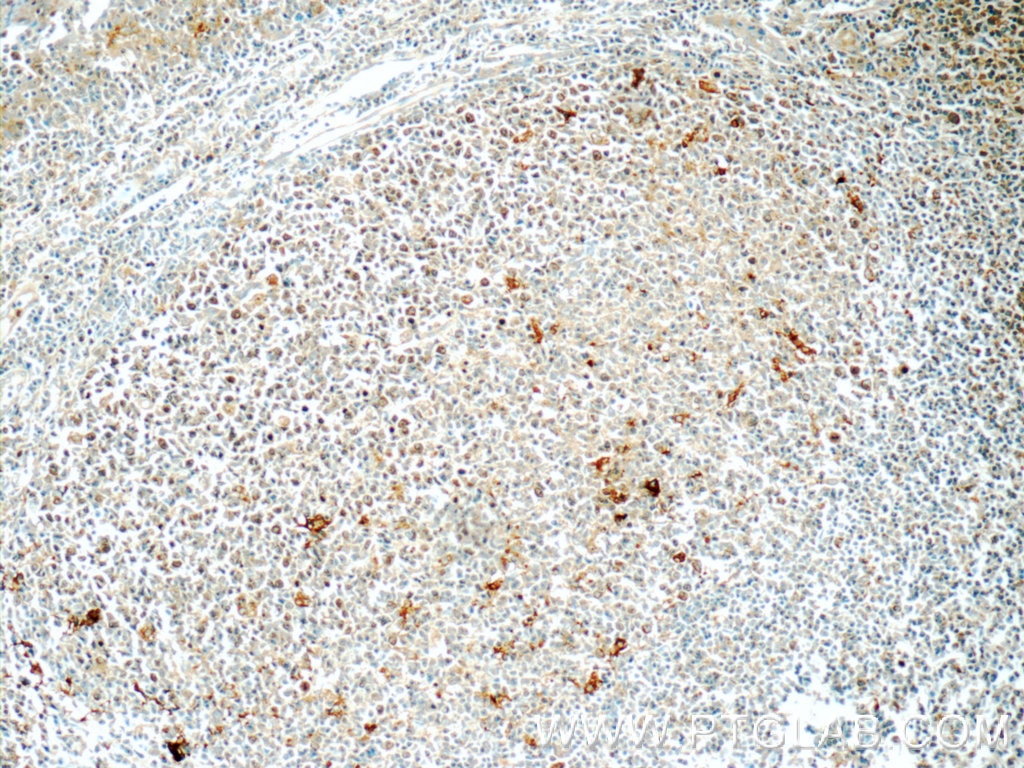 Immunohistochemistry (IHC) staining of human tonsillitis tissue using CLEC9A Polyclonal antibody (55451-1-AP)