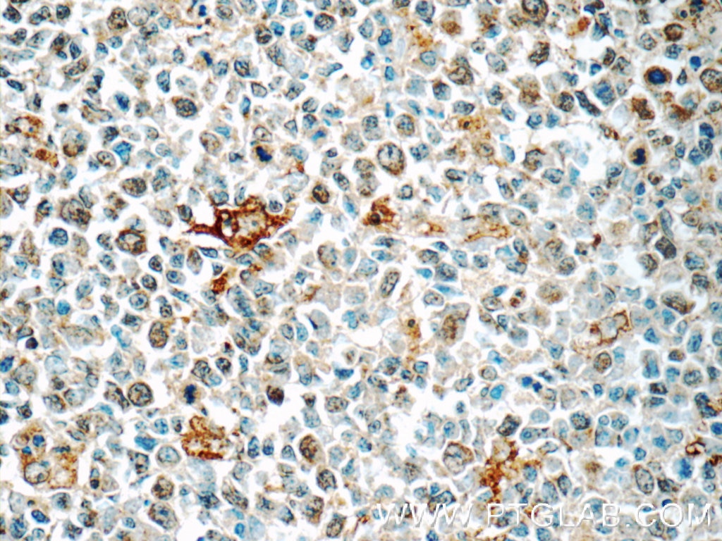 Immunohistochemistry (IHC) staining of human tonsillitis tissue using CLEC9A Polyclonal antibody (55451-1-AP)