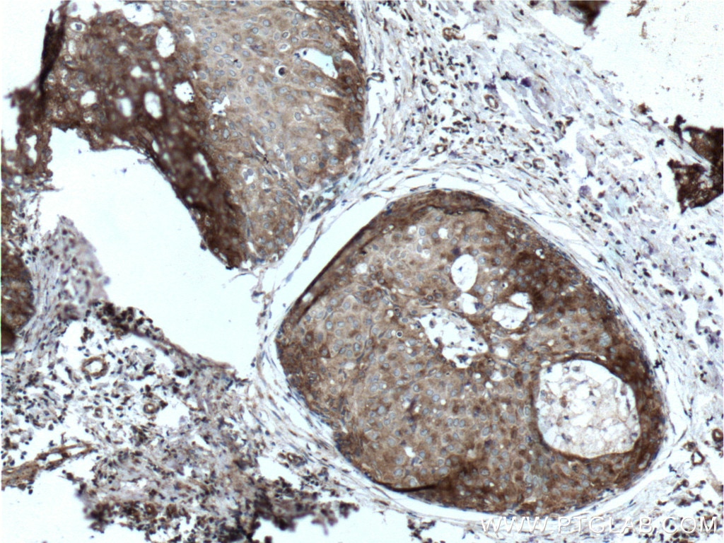Immunohistochemistry (IHC) staining of human breast cancer tissue using CLINT1 Polyclonal antibody (10470-1-AP)