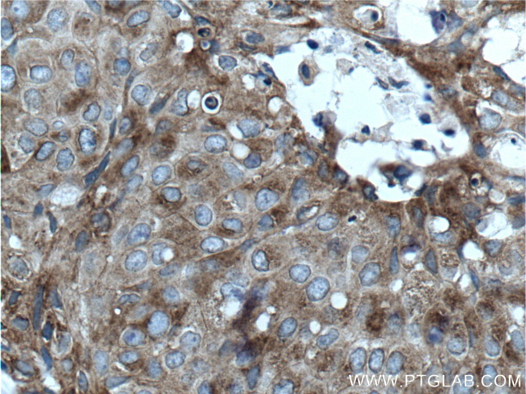 Immunohistochemistry (IHC) staining of human breast cancer tissue using CLINT1 Polyclonal antibody (10470-1-AP)