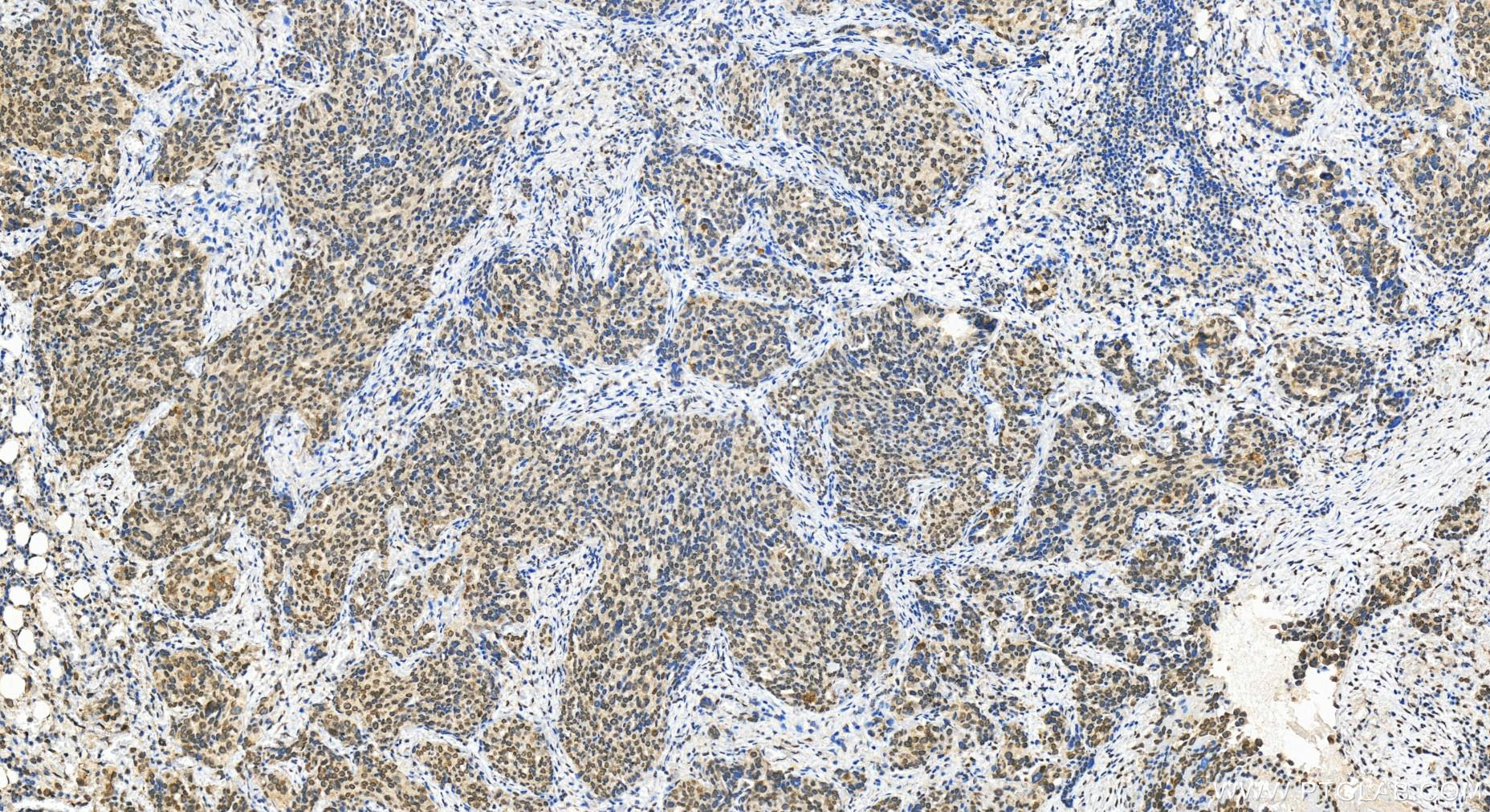 Immunohistochemistry (IHC) staining of human ovary cancer tissue using CLK3 Polyclonal antibody (28037-1-AP)
