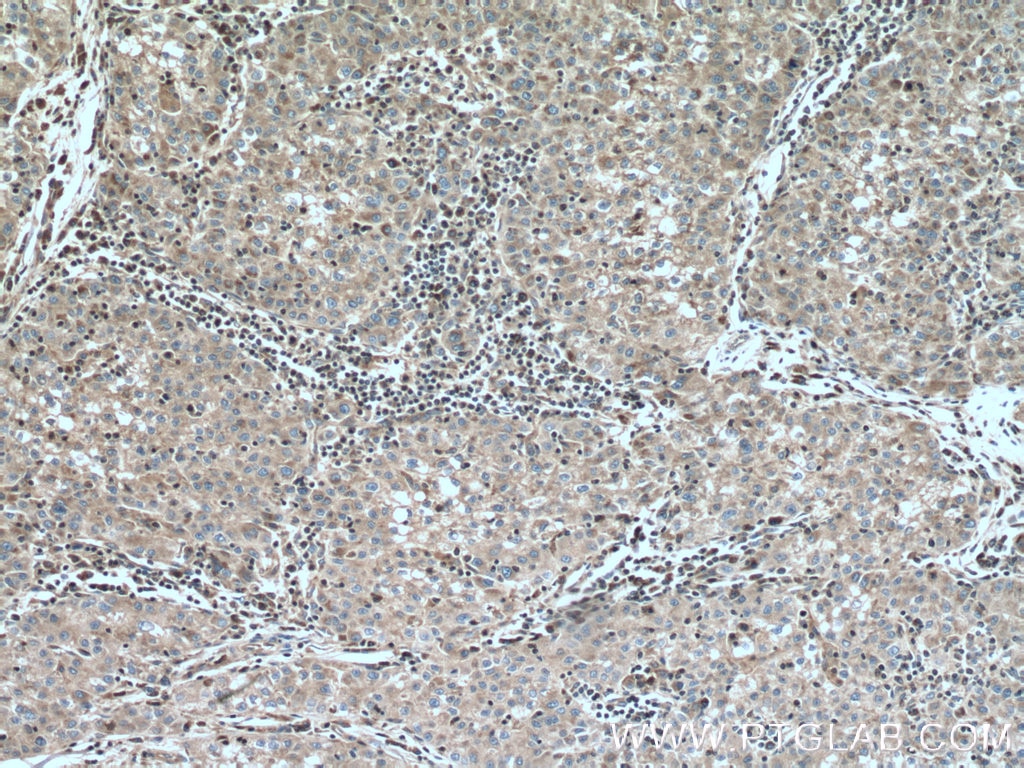 Immunohistochemistry (IHC) staining of human liver cancer tissue using CLPP Polyclonal antibody (15698-1-AP)