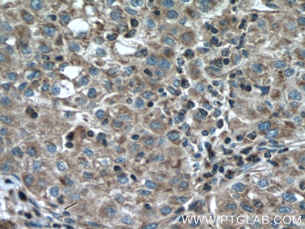 IHC staining of human liver cancer using 15698-1-AP