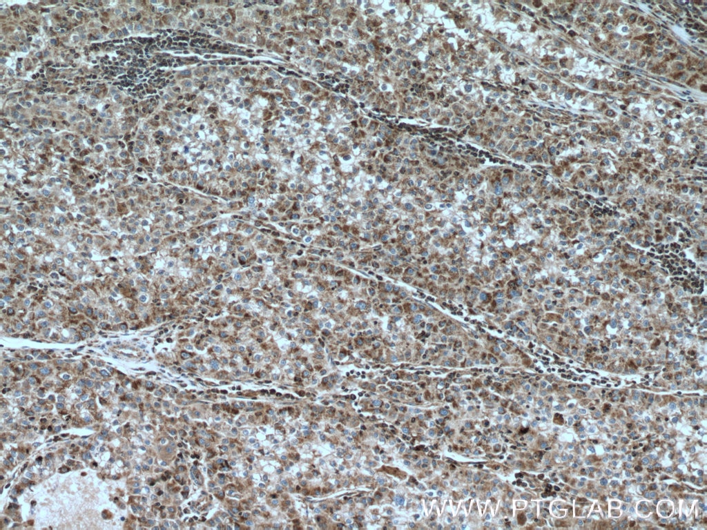 Immunohistochemistry (IHC) staining of human liver cancer tissue using CLPP Polyclonal antibody (15698-1-AP)