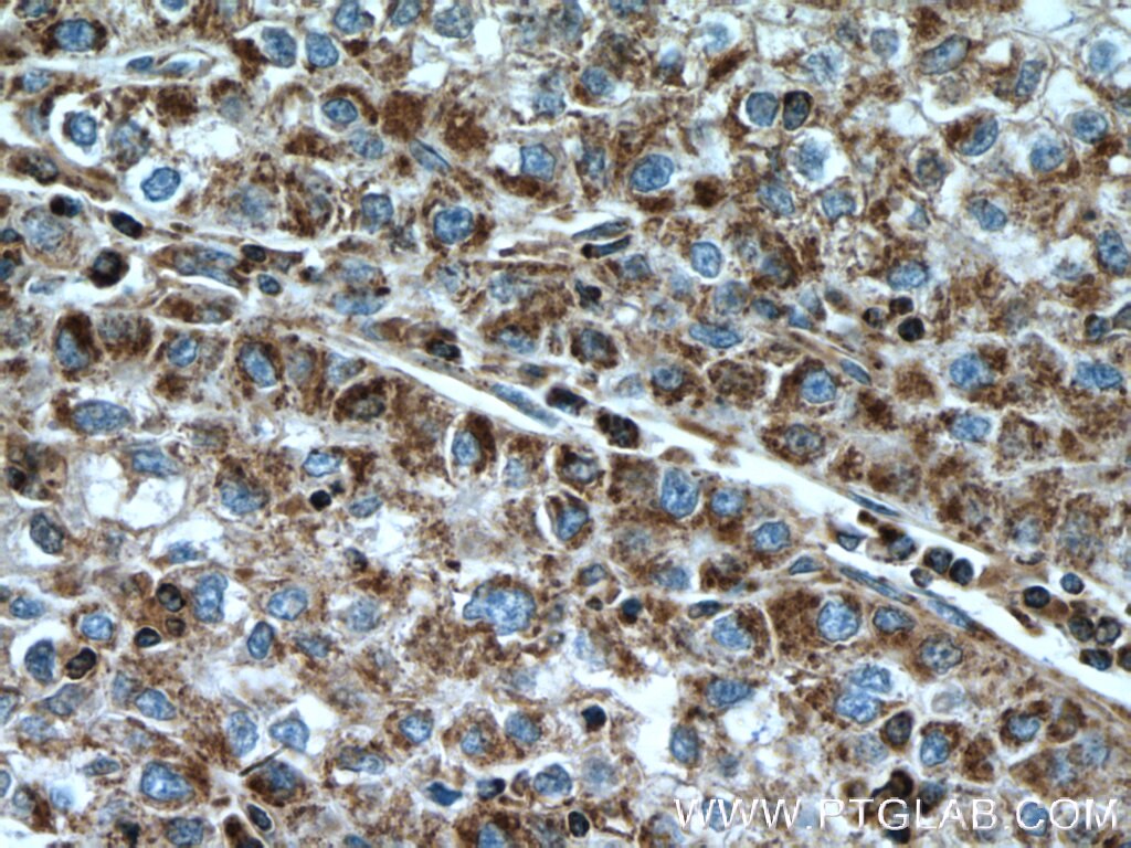 Immunohistochemistry (IHC) staining of human liver cancer tissue using CLPP Polyclonal antibody (15698-1-AP)