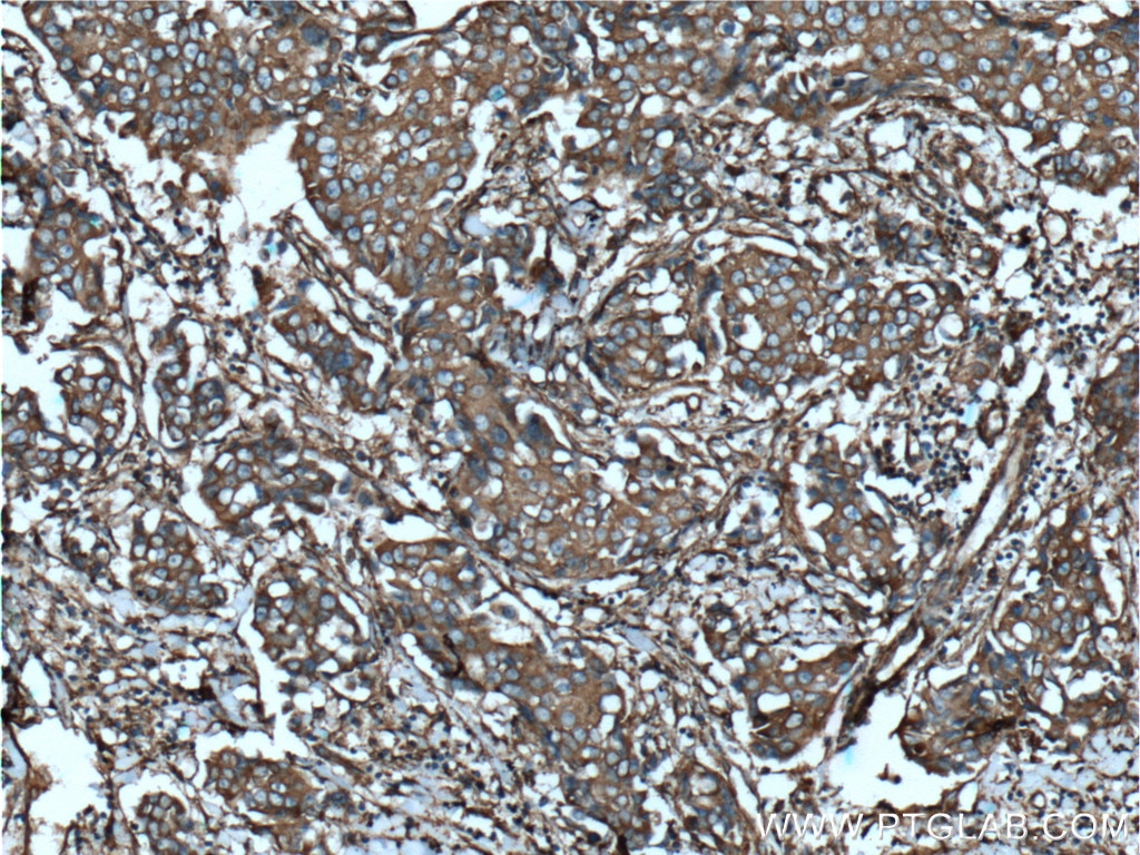 Immunohistochemistry (IHC) staining of human breast cancer tissue using CLTA Polyclonal antibody (10852-1-AP)