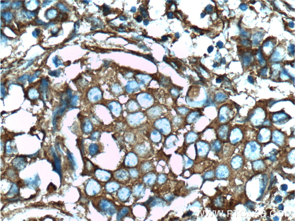 Immunohistochemistry (IHC) staining of human breast cancer tissue using CLTA Polyclonal antibody (10852-1-AP)