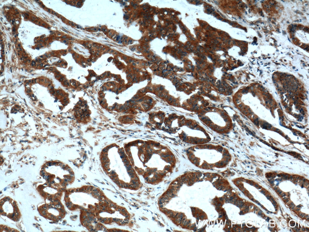 Immunohistochemistry (IHC) staining of human breast cancer tissue using CLTC Polyclonal antibody (26523-1-AP)