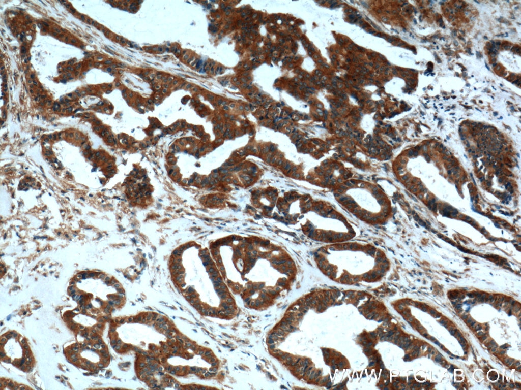 IHC staining of human breast cancer using 26523-1-AP