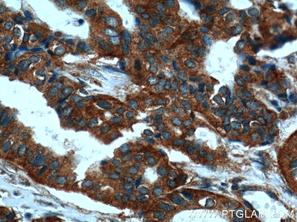 Immunohistochemistry (IHC) staining of human breast cancer tissue using CLTC Polyclonal antibody (26523-1-AP)