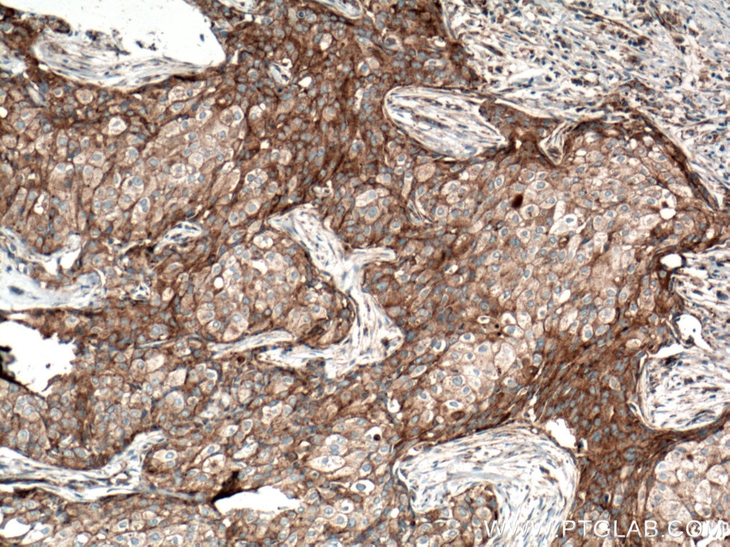 Immunohistochemistry (IHC) staining of human breast cancer tissue using CLTC Monoclonal antibody (66487-1-Ig)