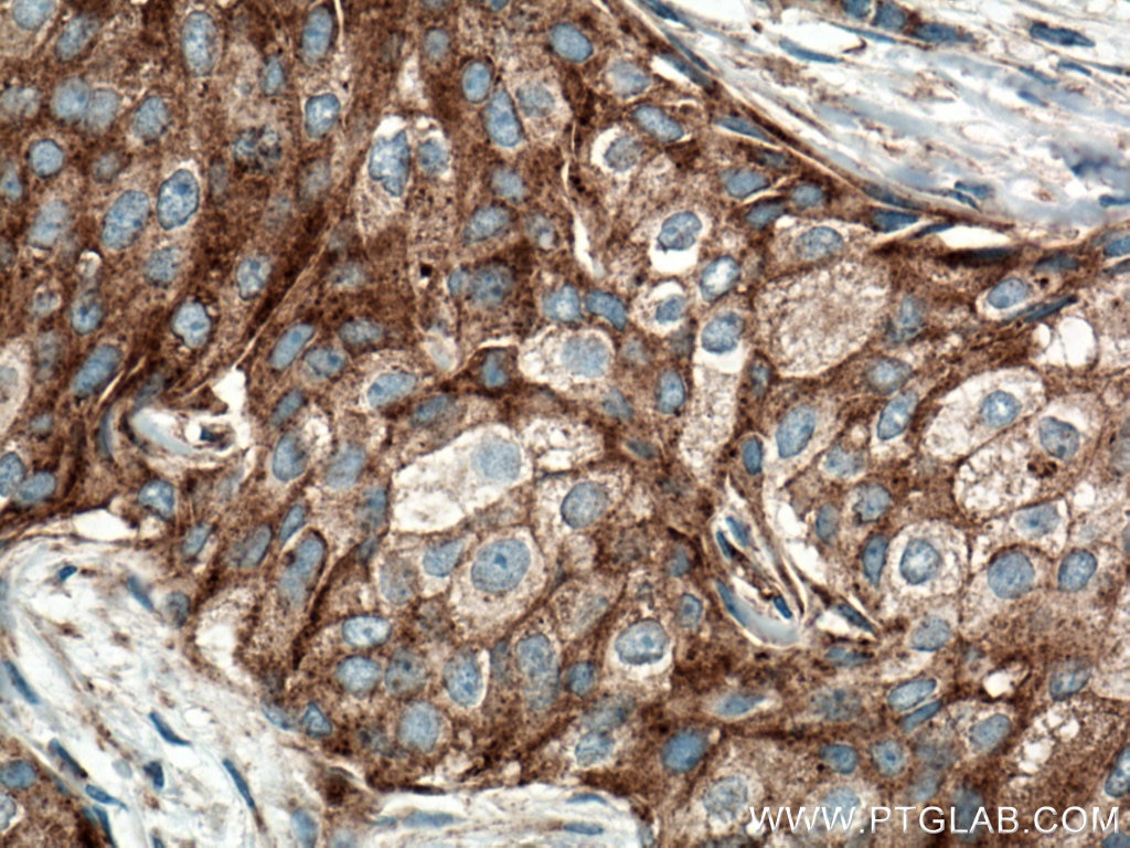 Immunohistochemistry (IHC) staining of human breast cancer tissue using CLTC Monoclonal antibody (66487-1-Ig)
