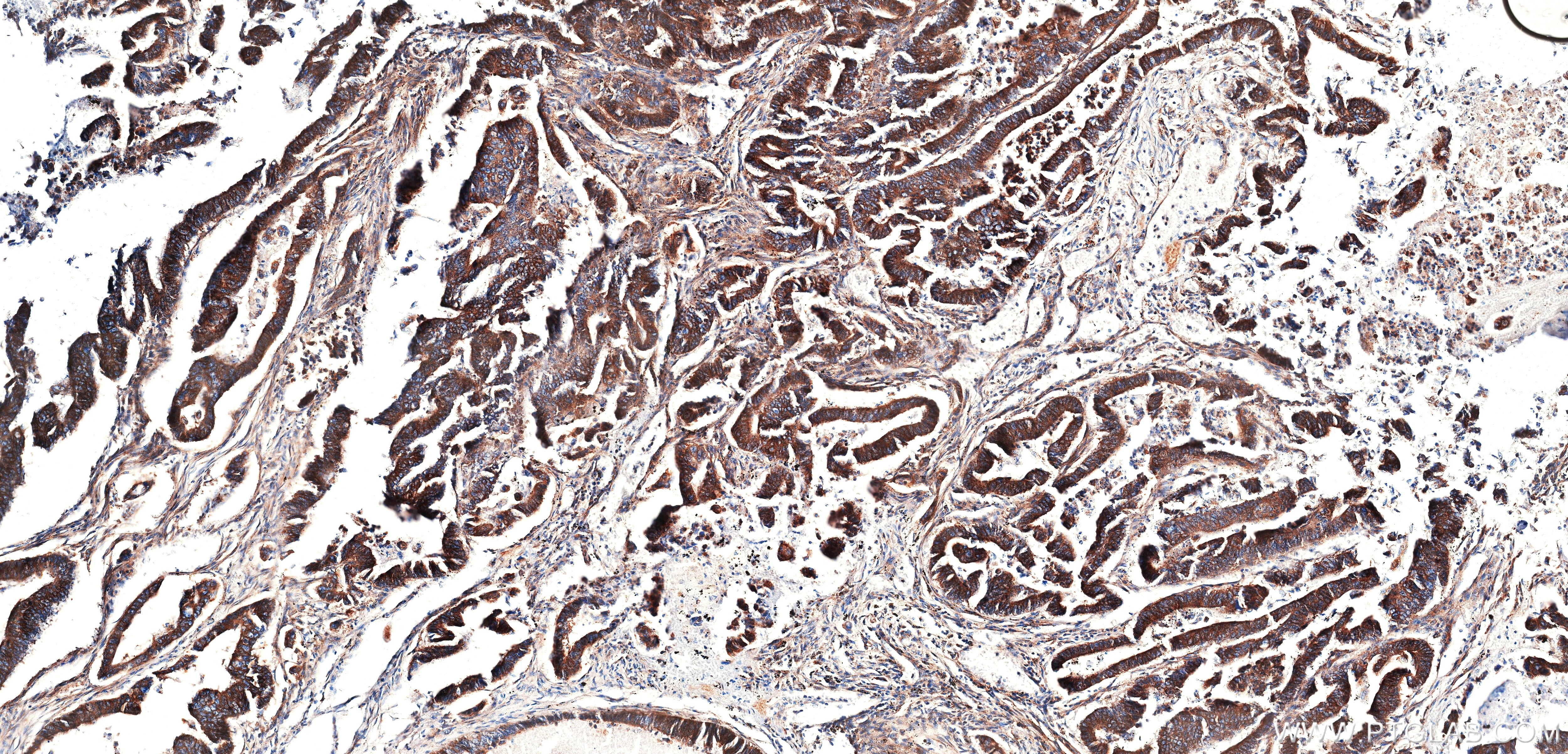 IHC staining of human colon cancer using 86660-3-RR Immunohistochemistry (IHC) staining of human colon cancer tissue using CLTC Recombinant monoclonal antibody (86660-3-RR)