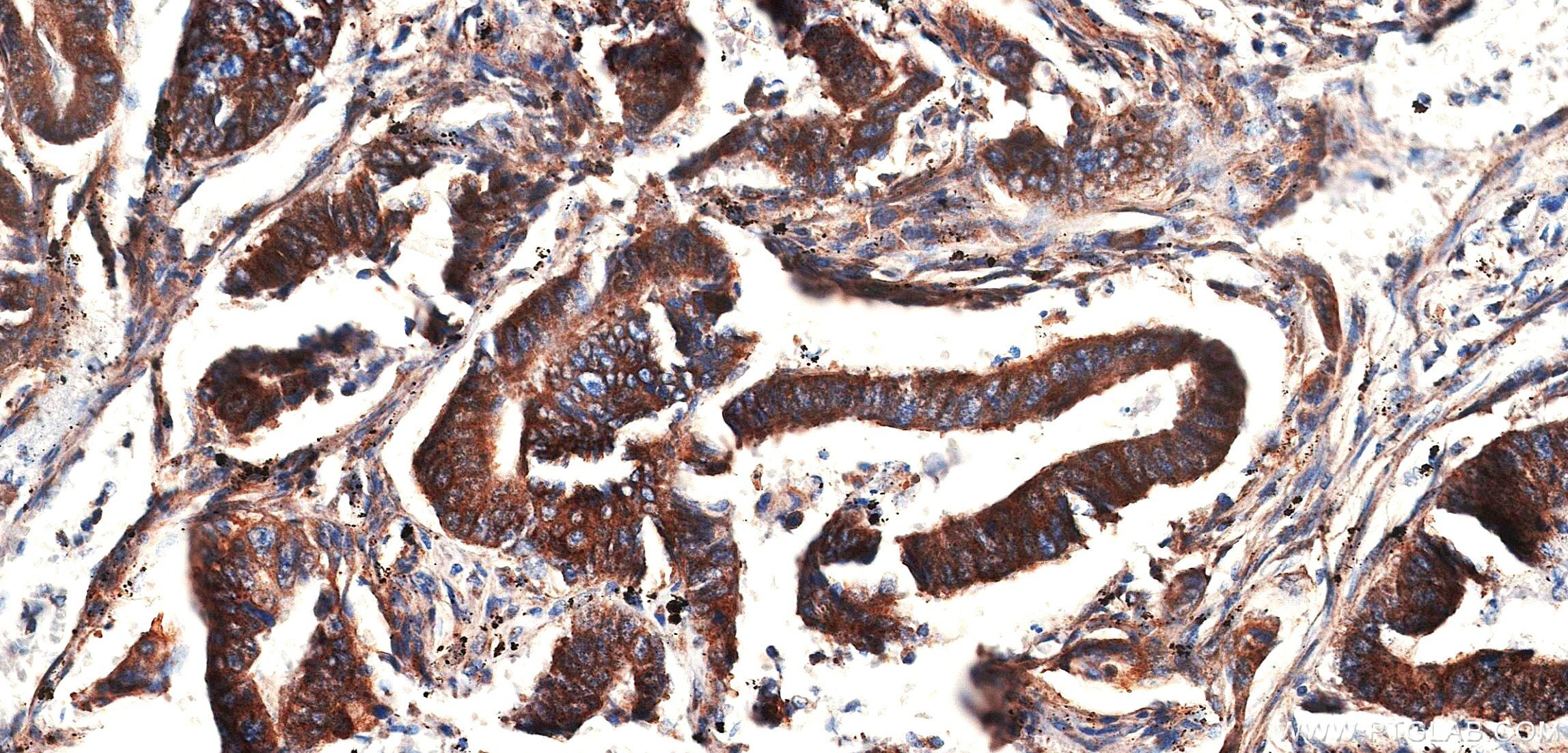 IHC staining of human colon cancer using 86660-3-RR Immunohistochemistry (IHC) staining of human colon cancer tissue using CLTC Recombinant monoclonal antibody (86660-3-RR)