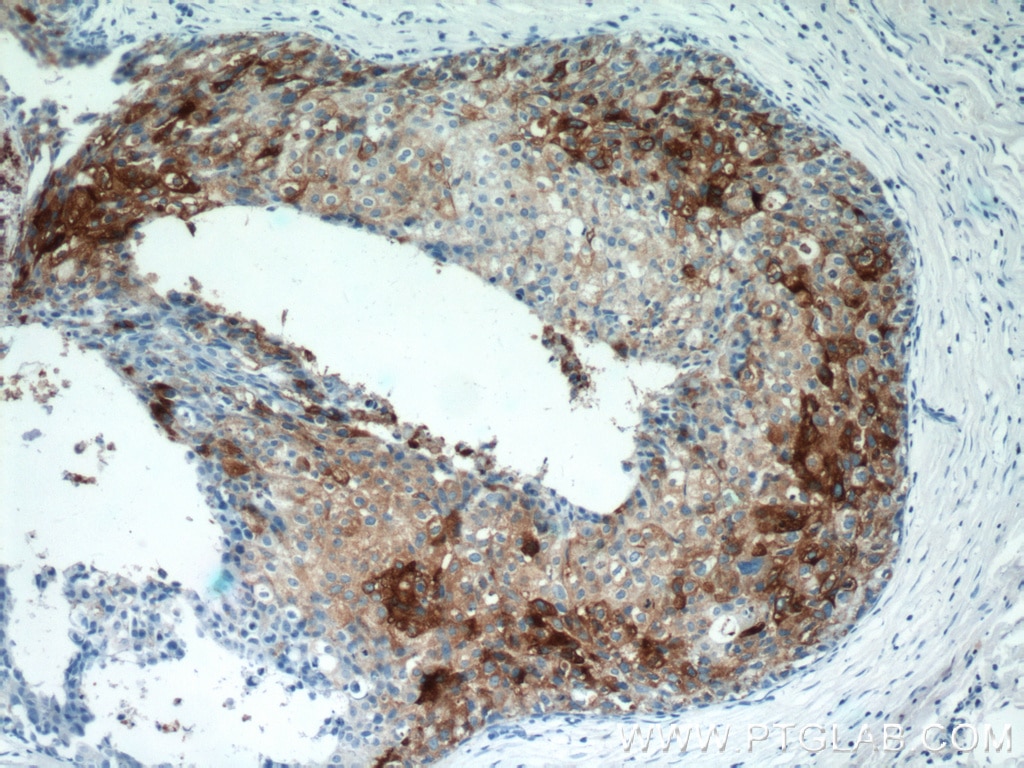 Immunohistochemistry (IHC) staining of human breast cancer tissue using Clusterin Polyclonal antibody (12289-1-AP)