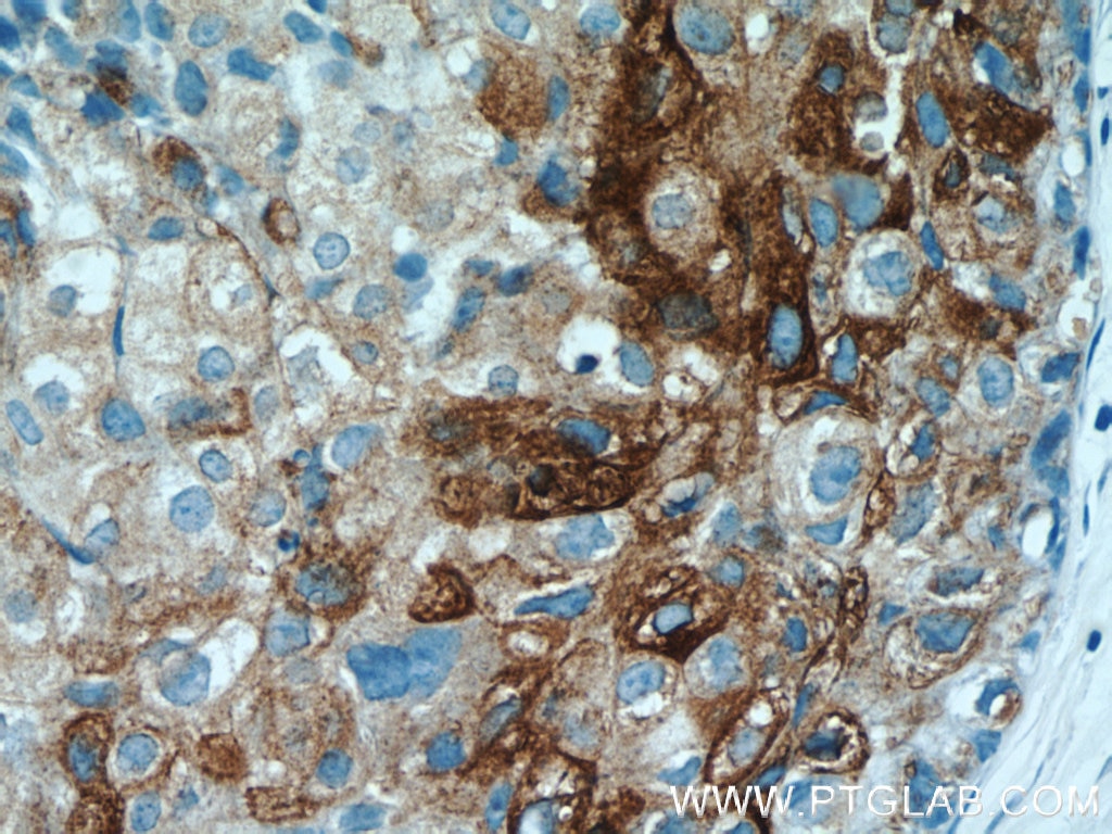 Immunohistochemistry (IHC) staining of human breast cancer tissue using Clusterin Polyclonal antibody (12289-1-AP)