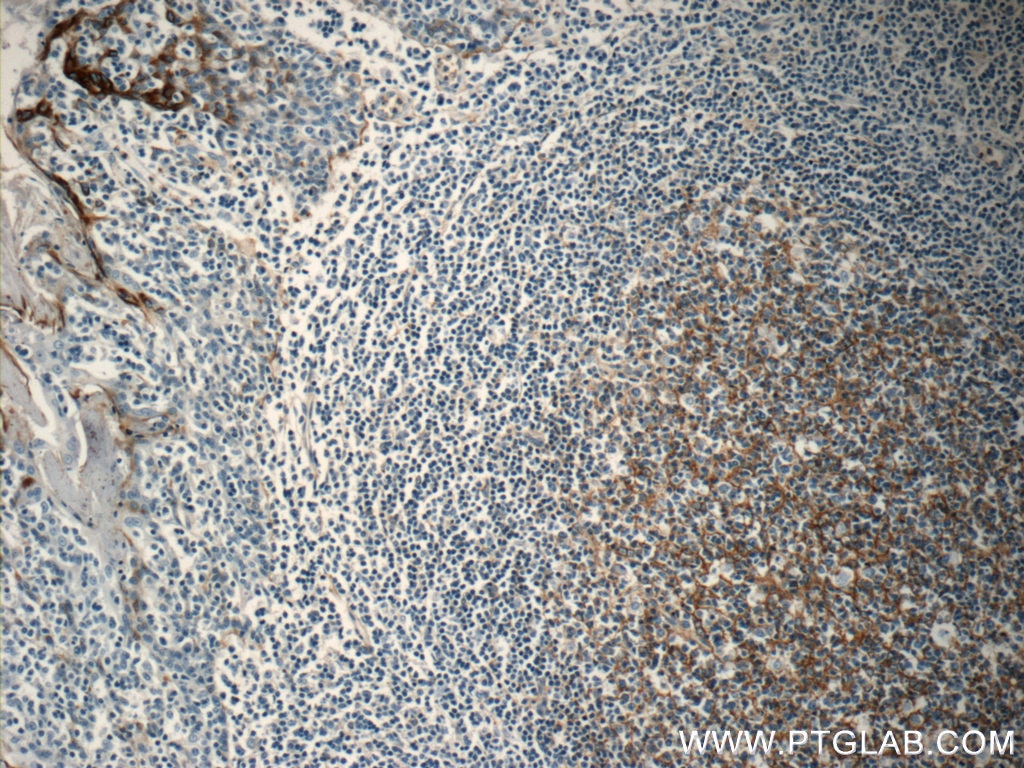 Immunohistochemistry (IHC) staining of human tonsillitis tissue using Clusterin Polyclonal antibody (12289-1-AP)