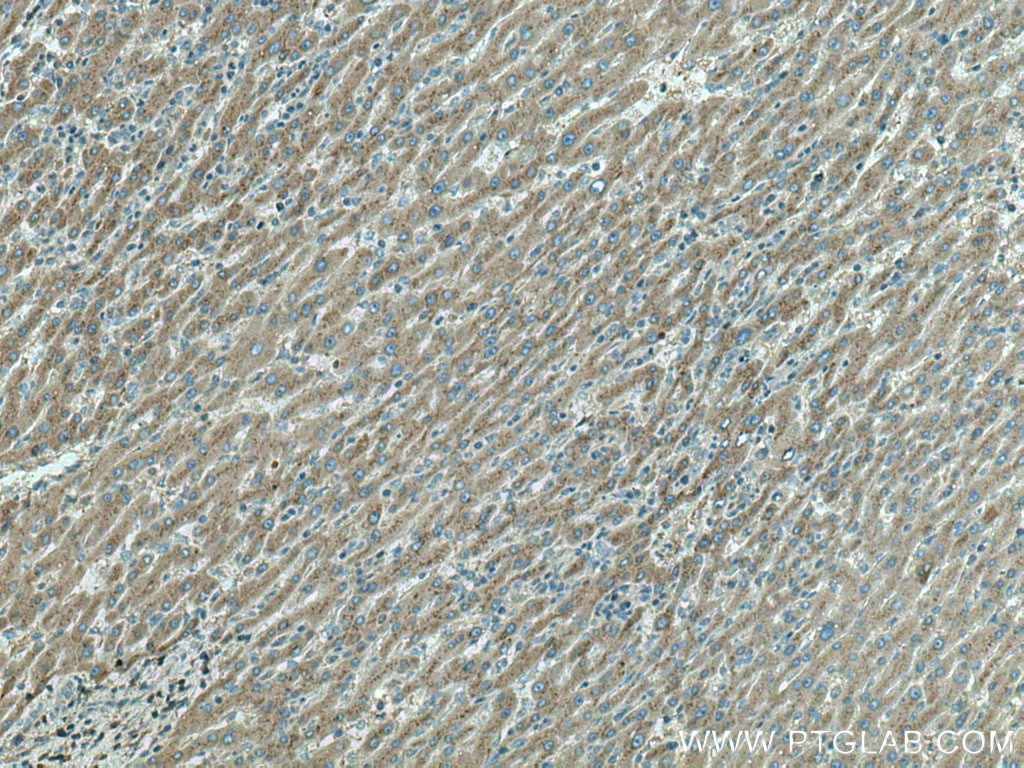 Immunohistochemistry (IHC) staining of human liver cancer tissue using Clusterin Polyclonal antibody (12289-1-AP)