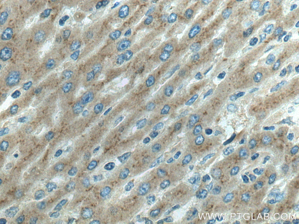 Immunohistochemistry (IHC) staining of human liver cancer tissue using Clusterin Polyclonal antibody (12289-1-AP)