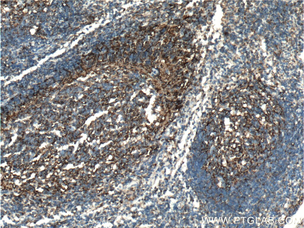 Immunohistochemistry (IHC) staining of human tonsillitis tissue using Clusterin Polyclonal antibody (12289-1-AP)