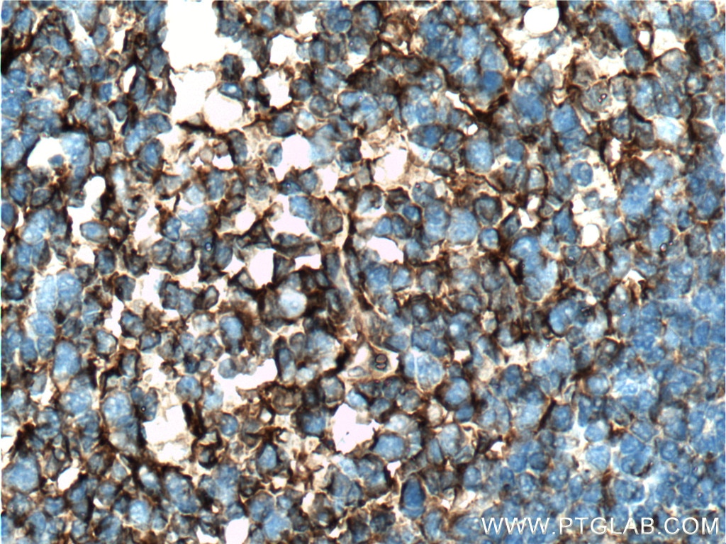 Immunohistochemistry (IHC) staining of human tonsillitis tissue using Clusterin Polyclonal antibody (12289-1-AP)