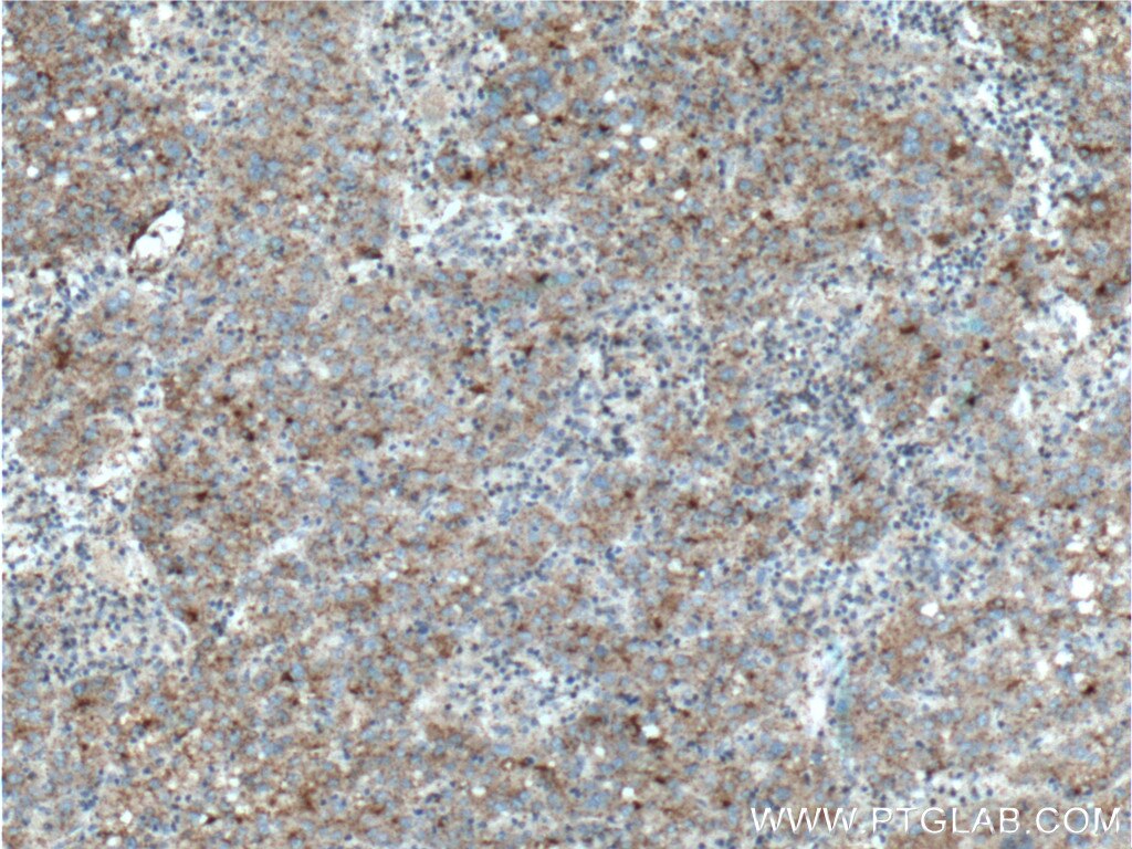Immunohistochemistry (IHC) staining of human liver cancer tissue using Clusterin Polyclonal antibody (12289-1-AP)