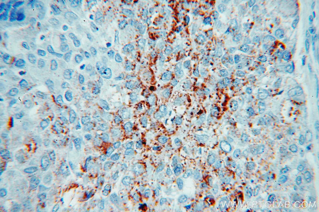 IHC staining of human liver cancer using 12289-1-AP