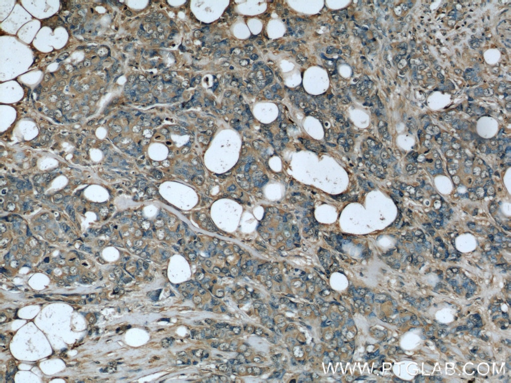 Immunohistochemistry (IHC) staining of human breast cancer tissue using Clusterin Monoclonal antibody (66109-1-Ig)