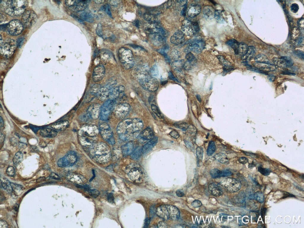 Immunohistochemistry (IHC) staining of human breast cancer tissue using Clusterin Monoclonal antibody (66109-1-Ig)