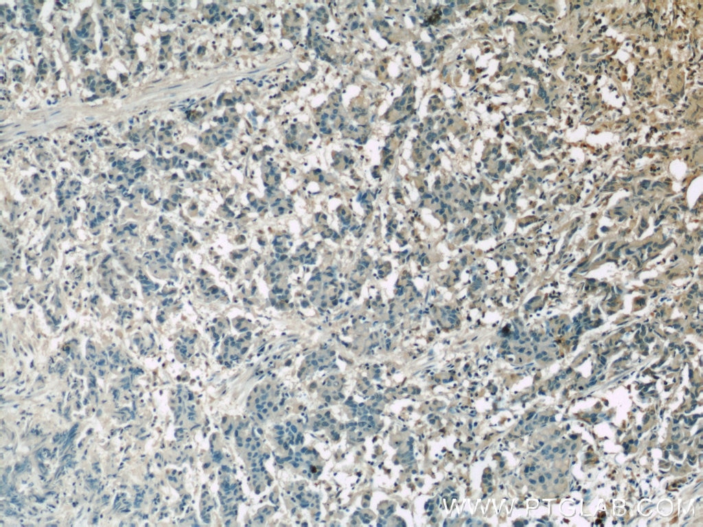 IHC staining of human prostate cancer using 66109-1-Ig