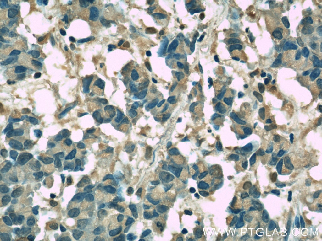 Immunohistochemistry (IHC) staining of human prostate cancer tissue using Clusterin Monoclonal antibody (66109-1-Ig)