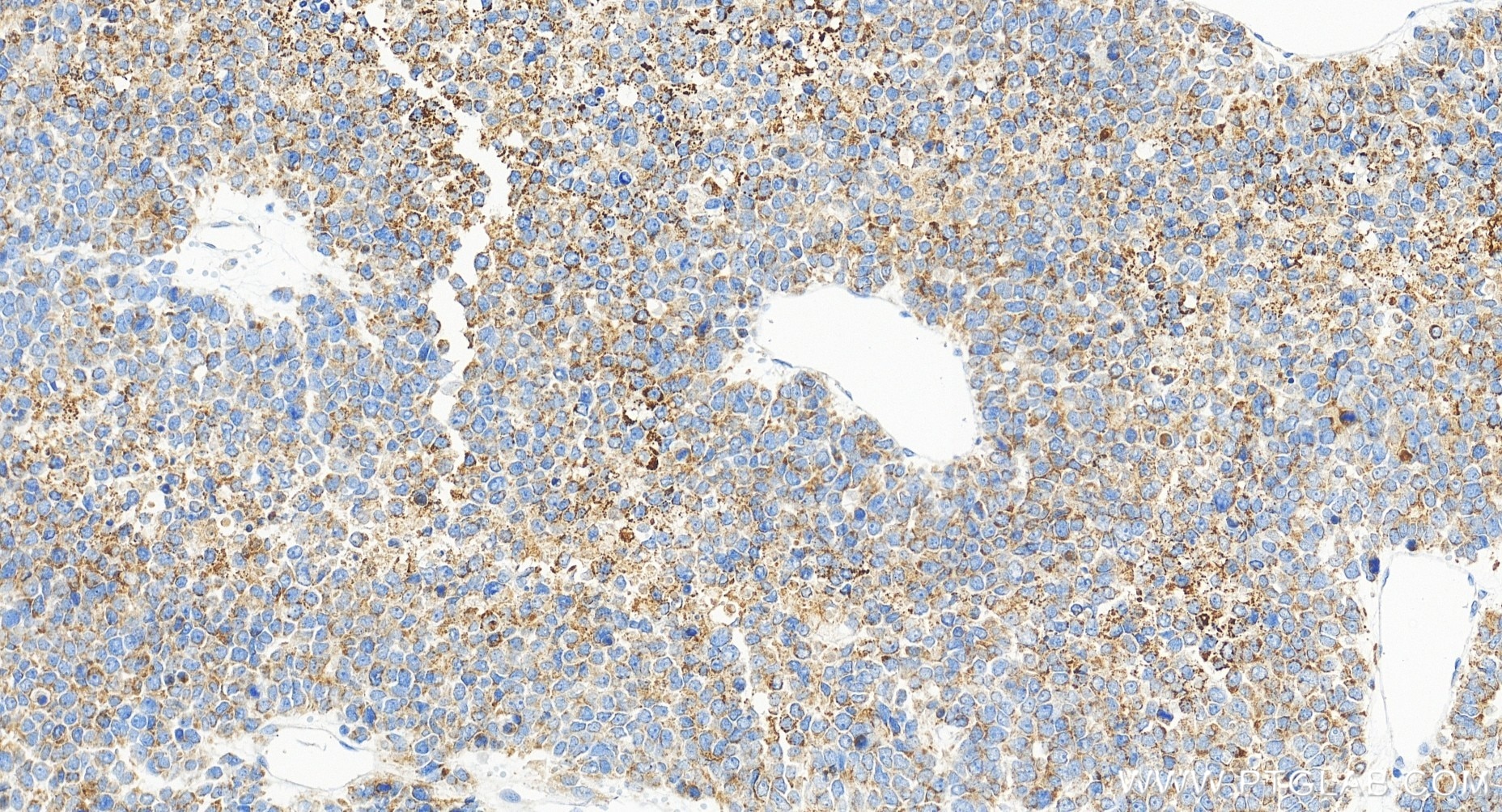 Immunohistochemical analysis of paraffin-embedded human liver cancer tissue slide using 85399-4-RR (CLYBL antibody) at dilution of 1:500 (under 20x lens). Heat mediated antigen retrieval with Tris-EDTA buffer (pH 9.0). Immunohistochemistry (IHC) staining of human liver cancer tissue using CLYBL Recombinant antibody (85399-4-RR)